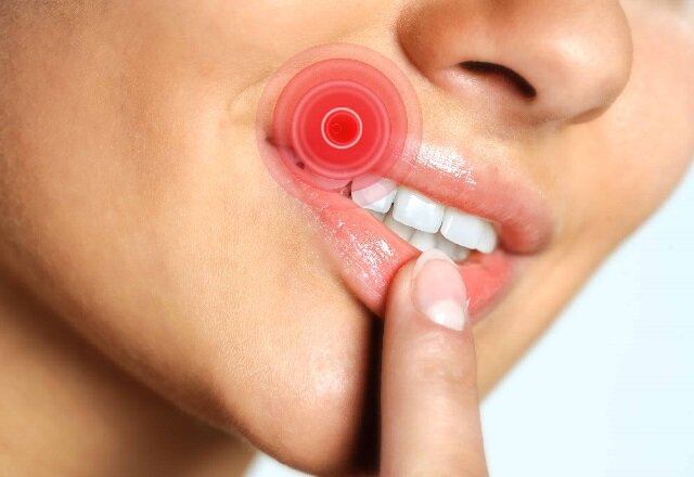 Герпес: как распознать и эффективно справиться с инфекцией